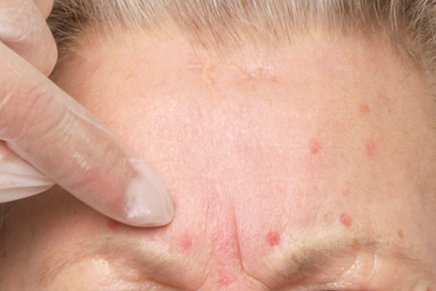 Botox